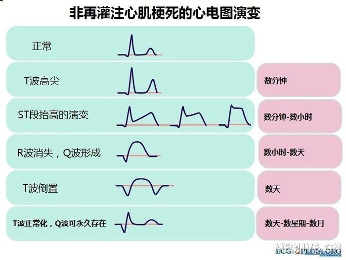 常见的异常心电图波形识别_心电图什么是异常q波_异常心电图波形