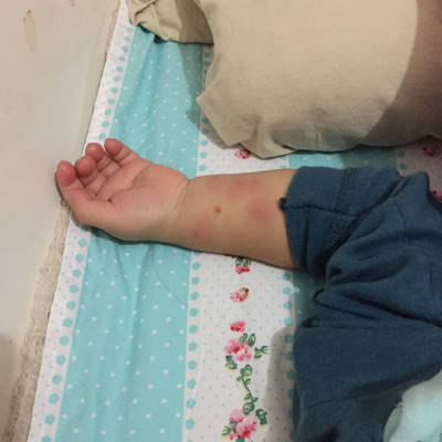 宝宝胳膊上红点图片会不会过敏_宝宝手臂上有红点如图_宝宝手臂上红点点