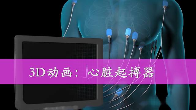心脏手术后起搏器线怎么拆_心脏起搏器手术多少钱_心脏起搏器术前术后