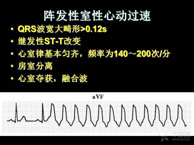 阵发性室上性心动过扑_阵发心房扑动_心室扑动室性心动过速