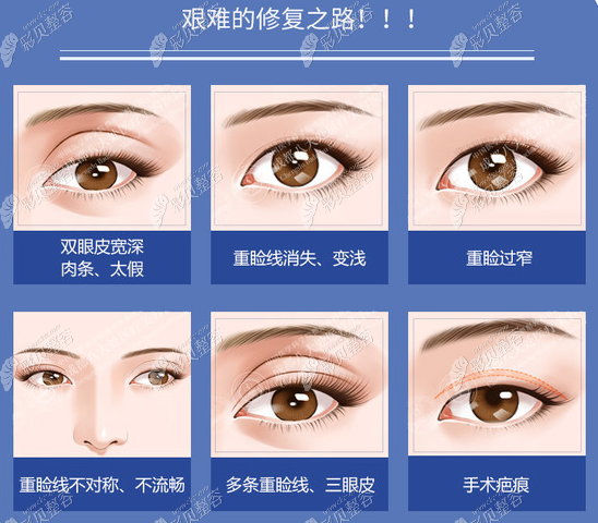 割原因老双眼皮显老怎么办_割原因老双眼皮显老吗_割双眼皮显老的原因