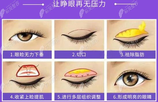 割原因老双眼皮显老吗_割原因老双眼皮显老怎么办_割双眼皮显老的原因