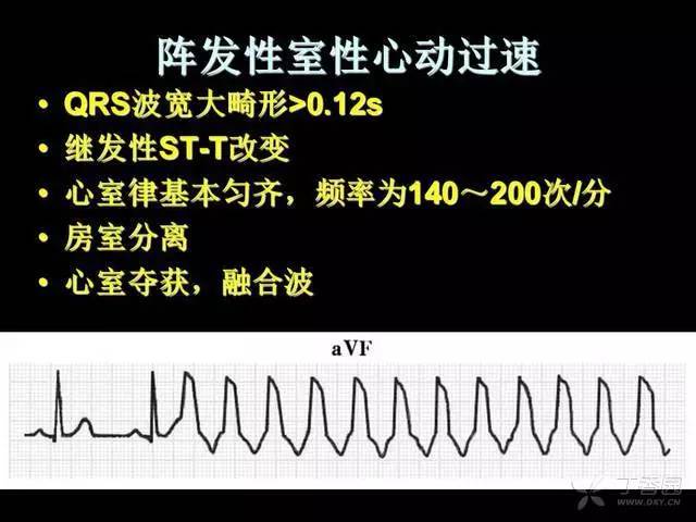 阵发性房动心动过速_阵发性室性心动过_阵发性室上性心动过速/治疗